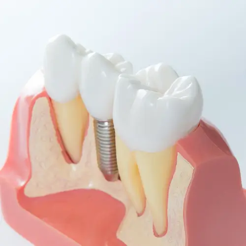 clinica odontológica h2 prime na imagem mostra um exemplo de dente implantado