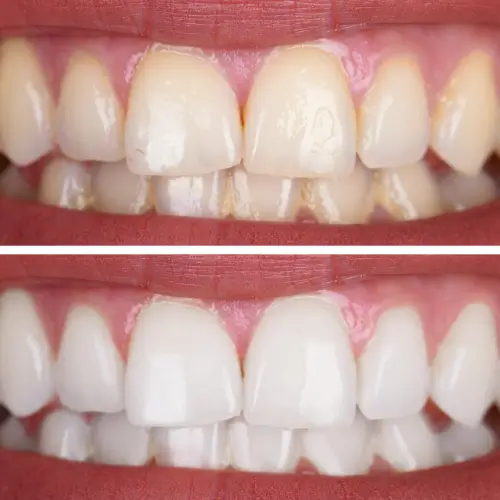 Imagem mostra o resultado de clareamento dental antes e depois